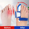 2PCS Orthopedic Toe Corrector