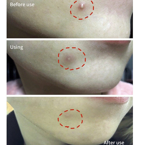 BREYLEE Acne Pimple Patch