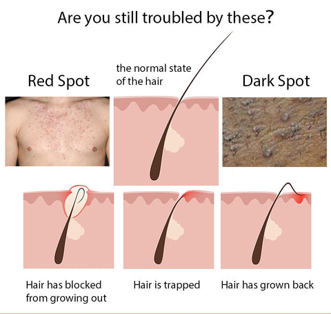 LANTHOME Razor Bump Solution for Ingrown Hair